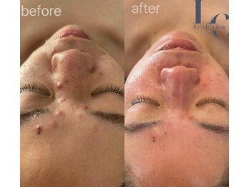 ルシェリア(Le cherien)/肌質改善REVIハーブピーリング