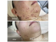 メイリー(MEILI)/ニキビケア10回効果