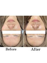 フォルチェ ゆめタウン広島店(Folche)/ソフトピーリング1回の変化