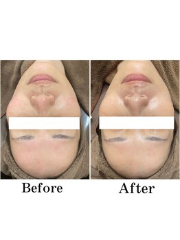 フォルチェ ゆめタウン広島店(Folche)/ソフトピーリング1回の変化