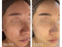 ビューティサロン アール(R)/ハーブピーリングでお肌悩み改善