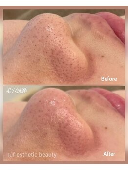 ルフ エステティック ビューティー(ruf esthetic beauty)/毛穴洗浄