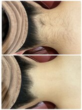 エステティック レイビス 銀座店(RAYVIS)/うなじ脱毛