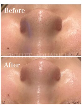 ホワイトアクア 四日市店(WHITE AQUA)/毛穴洗浄/毛穴改善