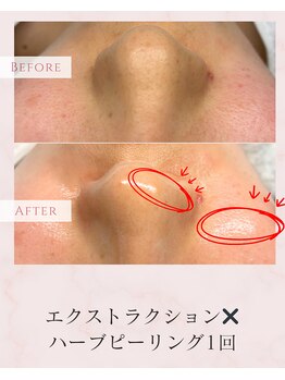 ジーンバイピエル 中野店(gene by PIEL)/#毛穴ケア#ピーリング#ワックス