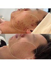 エトレ(etre)/肌管理プログラム8回終了後/毛穴