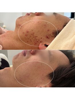 エトレ(etre)/肌管理プログラム8回終了後/毛穴