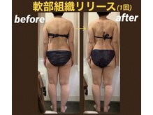 レアフィート(Rheafeet)/軟部組織のリリース　症例写真