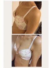 美人バスト アンド ヒップアップ 広島店/バストアップ症例写真