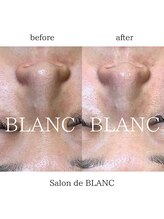 サロン ド ブラン アオヤマ(Salon de BLANC AOYAMA)/美肌ケアと小顔ケア！