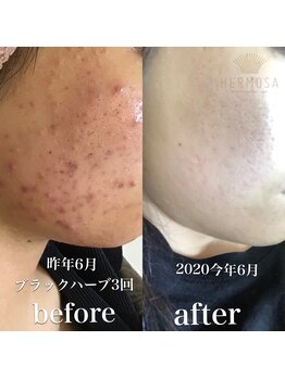 アネラ(ANELA)/エルモサハーブ症例.4