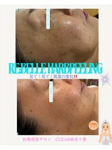 クリア 麻布十番(CLEAR)/ リベルハーブピーリング　剥離