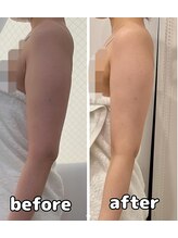 アモ(amo)/脂肪冷却1回ビフォーアフター