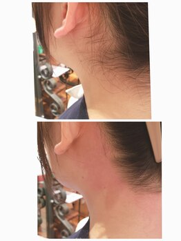 プトゥリ(Putri)/うなじ脱毛