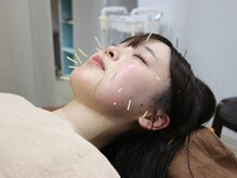 みのり鍼灸整骨院【肩こり/腰痛/小顔美容鍼/眼精疲労/自律神経/整体/睡眠/肩甲骨】の雰囲気(内側から引き上げる!美容鍼でたるみ・むくみを集中ケア!)