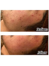 アクアプラス(AQUA+)/陶肌トリートメント20代男性