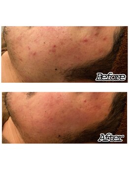 アクアプラス(AQUA+)/陶肌トリートメント20代男性