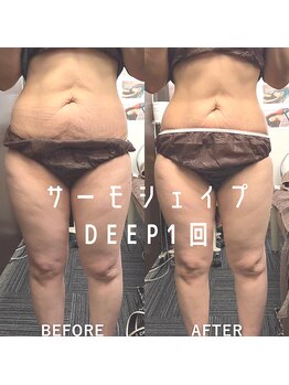 リラクゼーションサロン ラキ(laki)/サーモシェイプDEEP/痩身