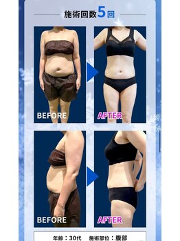 ルアナ(Luana)/話題の脂肪冷却ダイエット♪