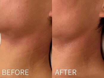 ケアズ(CARES)/首にもハーブピーリングを