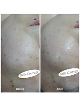 ベルクラージュ(Belle Courage)/30代　毛穴