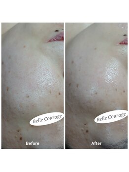 ベルクラージュ(Belle Courage)/30代　毛穴