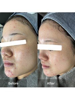 モカ 天王寺店(MOKA)/剥離ハーブピーリングニキビケア