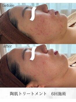 サロン モア(salon more)/ニキビ