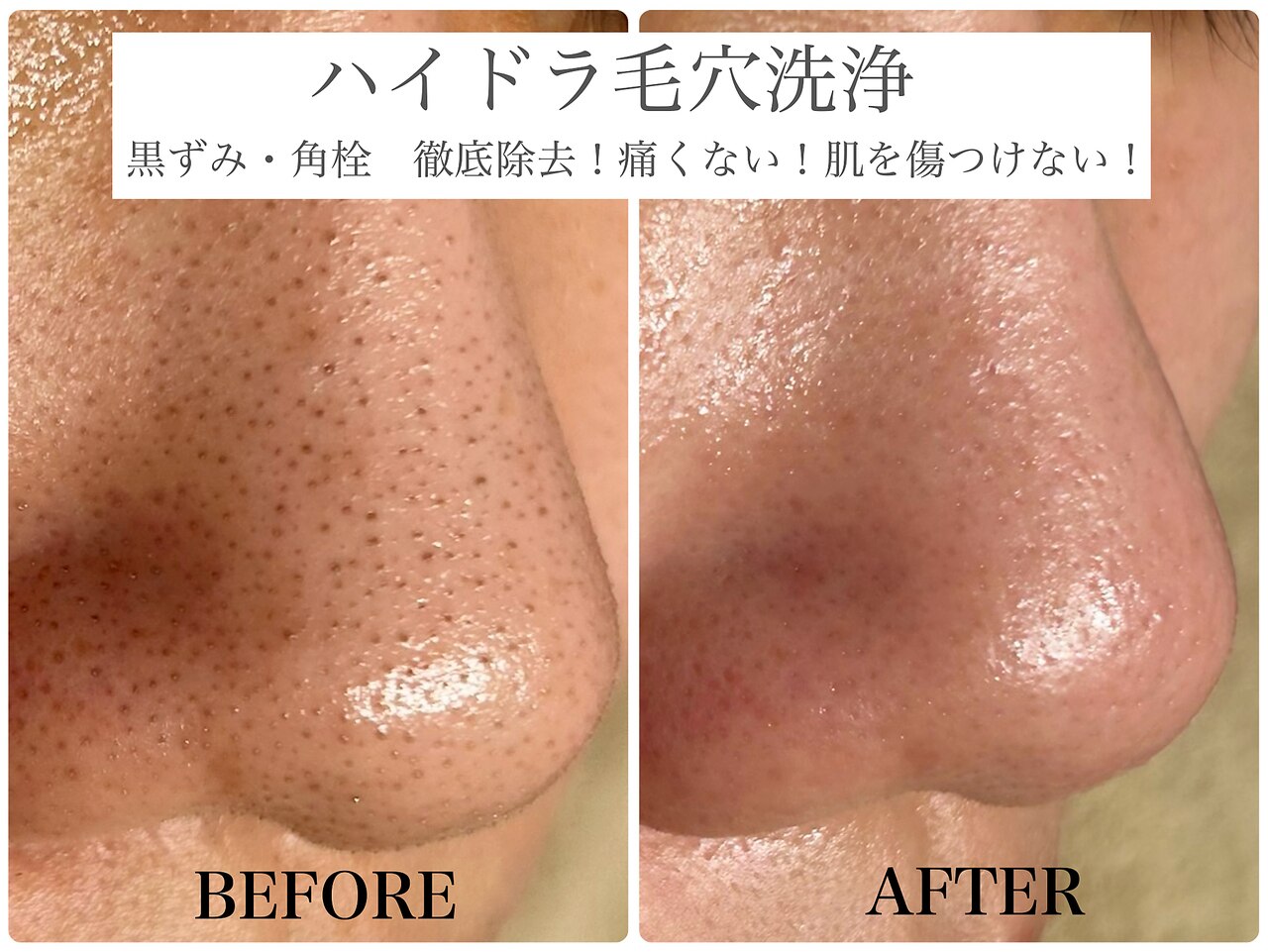 福島県で毛穴ケアが人気のエステサロン｜ホットペッパービューティー