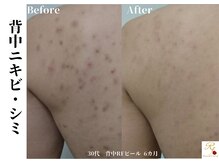 ローズフィールド(Rosefield)/RFピール/背中ニキビ/シミ/毛穴