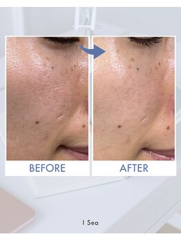 アイシー(I Sea)の写真/毛穴の開きとファンデが詰まる悩みに!バザルトフェイシャルで艶肌を叶える時間★