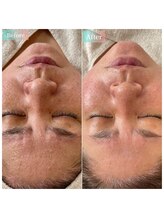 ミラビューティー(Mira Beauty)/気になる毛穴・凹凸にプラズマ