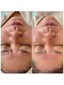 ミラビューティー(Mira Beauty)/気になる毛穴・凹凸にプラズマ