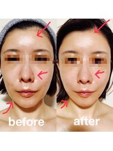 ララルアナ(Lara luana)/小顔＆むくみスッキリ