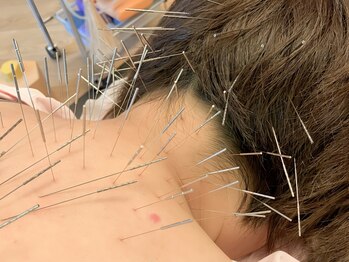 鍼灸かんなり治療院の写真/【首・肩こりに直接アプローチ！】コリを的確にあて深層までアプローチすることでお痛みを根本改善へ導く♪