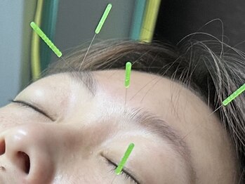 グリーン整骨院の写真/【疲れ・むくみ・眼精疲労・腰痛・凝り・たるみにお悩みの方へ】鍼施術で辛い身体の不調や肌悩みも改善！
