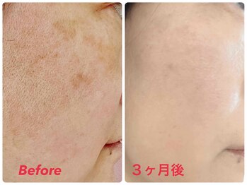 セラピア(Serapia)/水光ピーリング