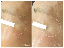 ラミーユ(La Miu)/【１回で目じりのシワが改善】