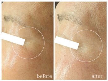 ラミーユ(La Miu)/【１回で目じりのシワが改善】