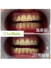 ルブラン 奈良店(Le Blanc)/清潔感のある歯に！