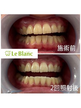 ルブラン 奈良店(Le Blanc)/清潔感のある歯に！