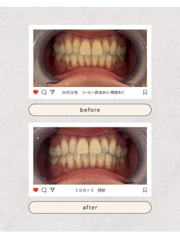 スマイルプライベートビューティサロン(Smile)/セルフホワイトニング