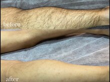 エリクサー 加須店(Elixir)/12回の施術でbefore after