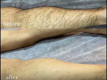 エリクサー 加須店(Elixir)/12回の施術でbefore after