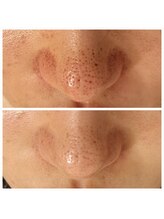 エリン(ERIN)/毛穴徹底洗浄×ピーリング