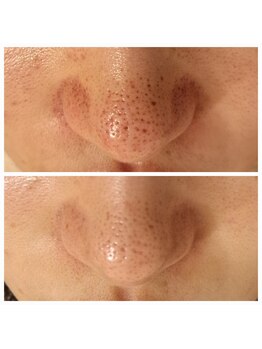 エリン(ERIN)/毛穴徹底洗浄×ピーリング