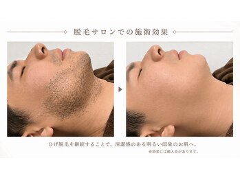 ベルバイグレイス(BELLE by grace)の写真/お肌に優しい脱毛で、毎日のお手入れの時短に◎清潔感を保ち、好感度もUP♪脱毛初心者の方にもオススメ◎