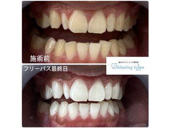 ホワイトニングサロン 熊本店/熊本県のホワイトニング
