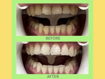 ココティ ホワイトニング(Cocotii)/ビフォーアフター