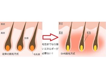 ルーク(RuCu)/SHR脱毛について